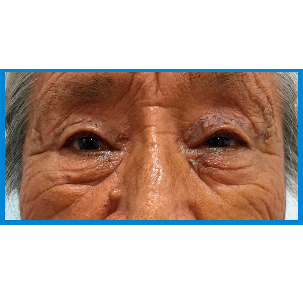 After-Ptosis Palpebral