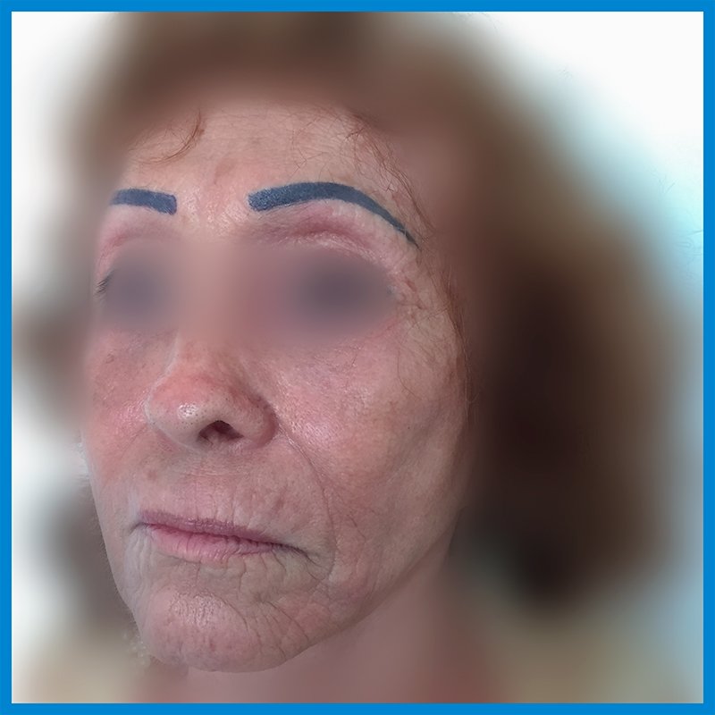 After-Lipoinyección Facial