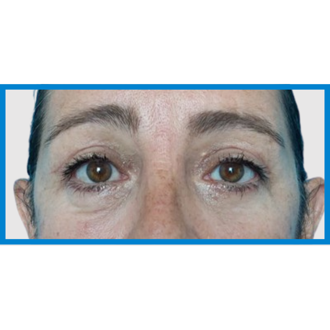 After-Blefaroplastia