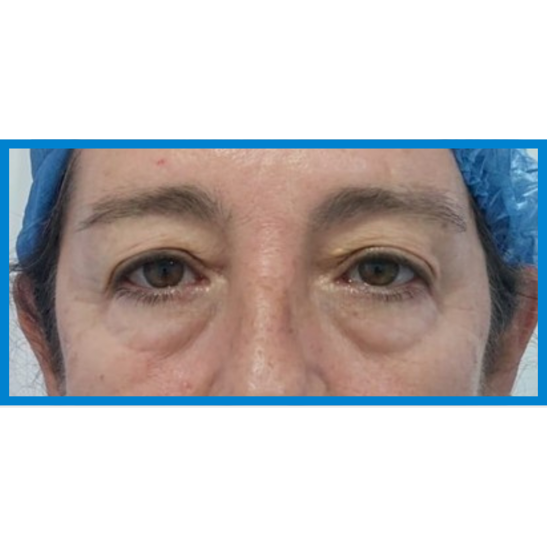 Before-Blefaroplastia