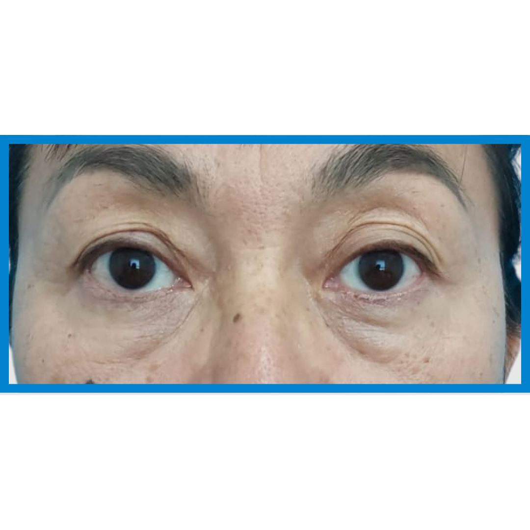 Before-Blefaroplastia