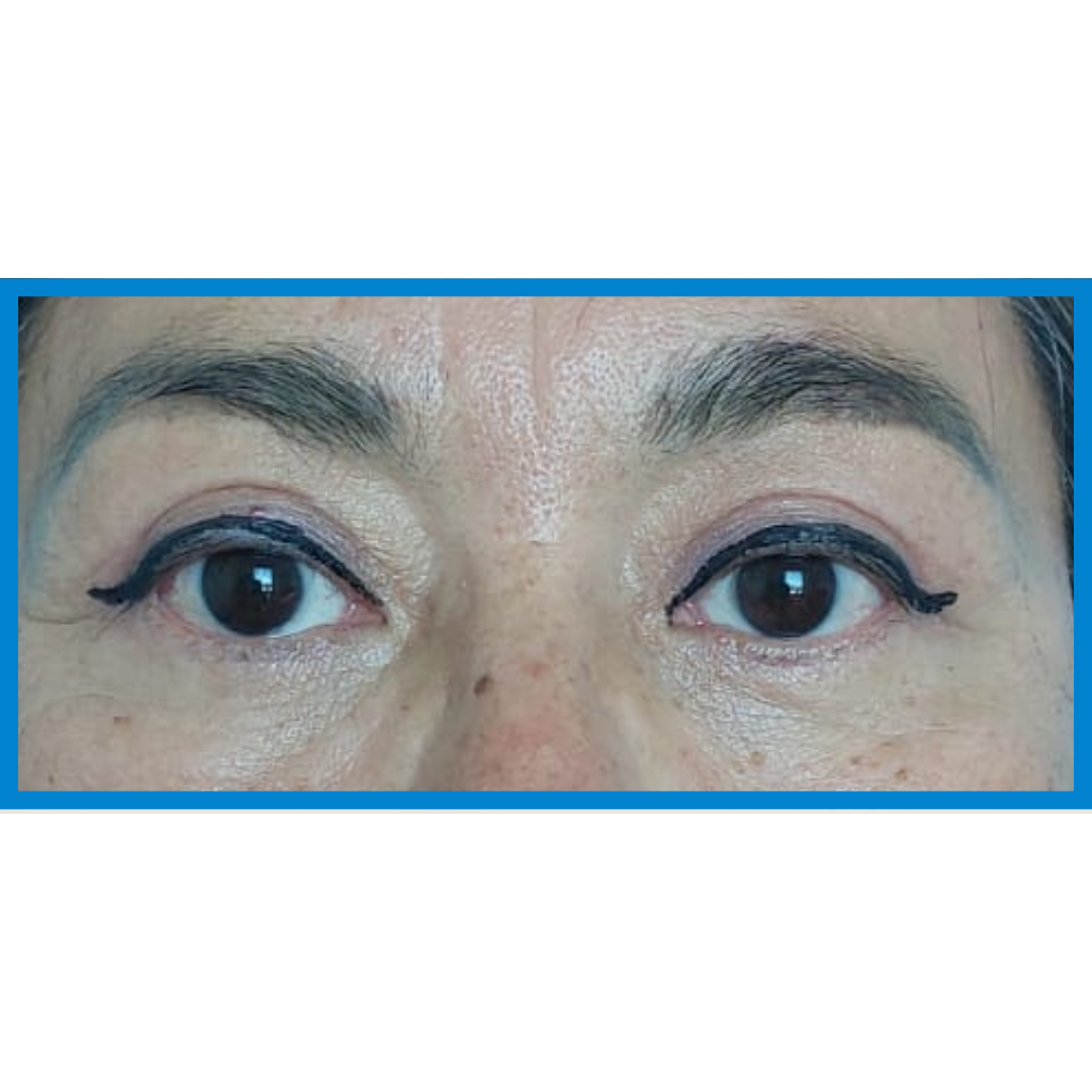 After-Blefaroplastia