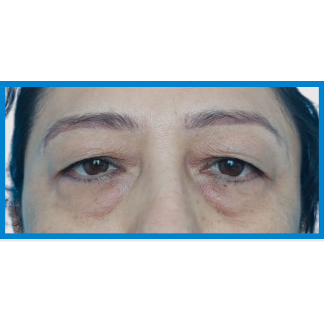 Before-Blefaroplastia