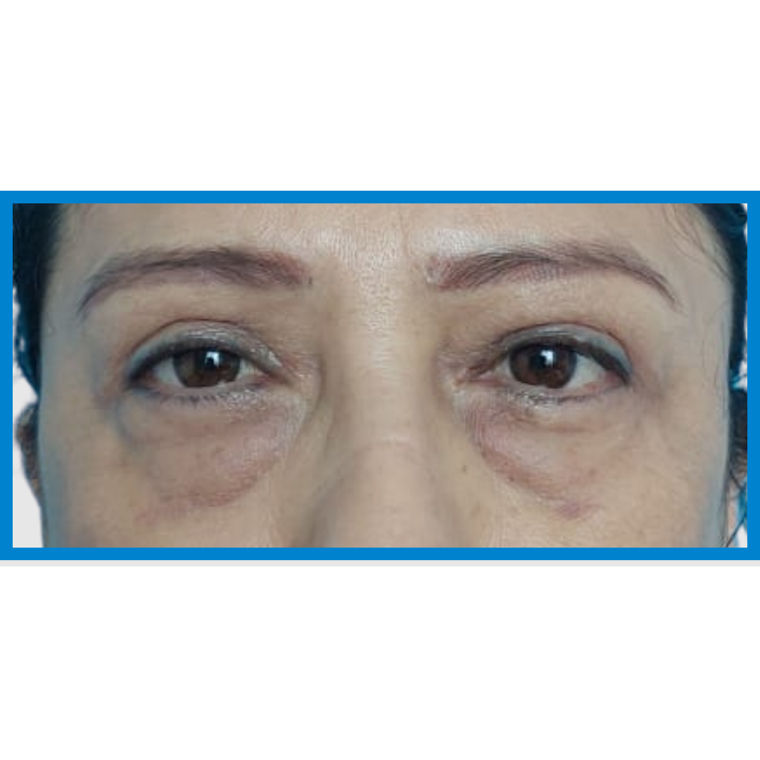 After-Blefaroplastia