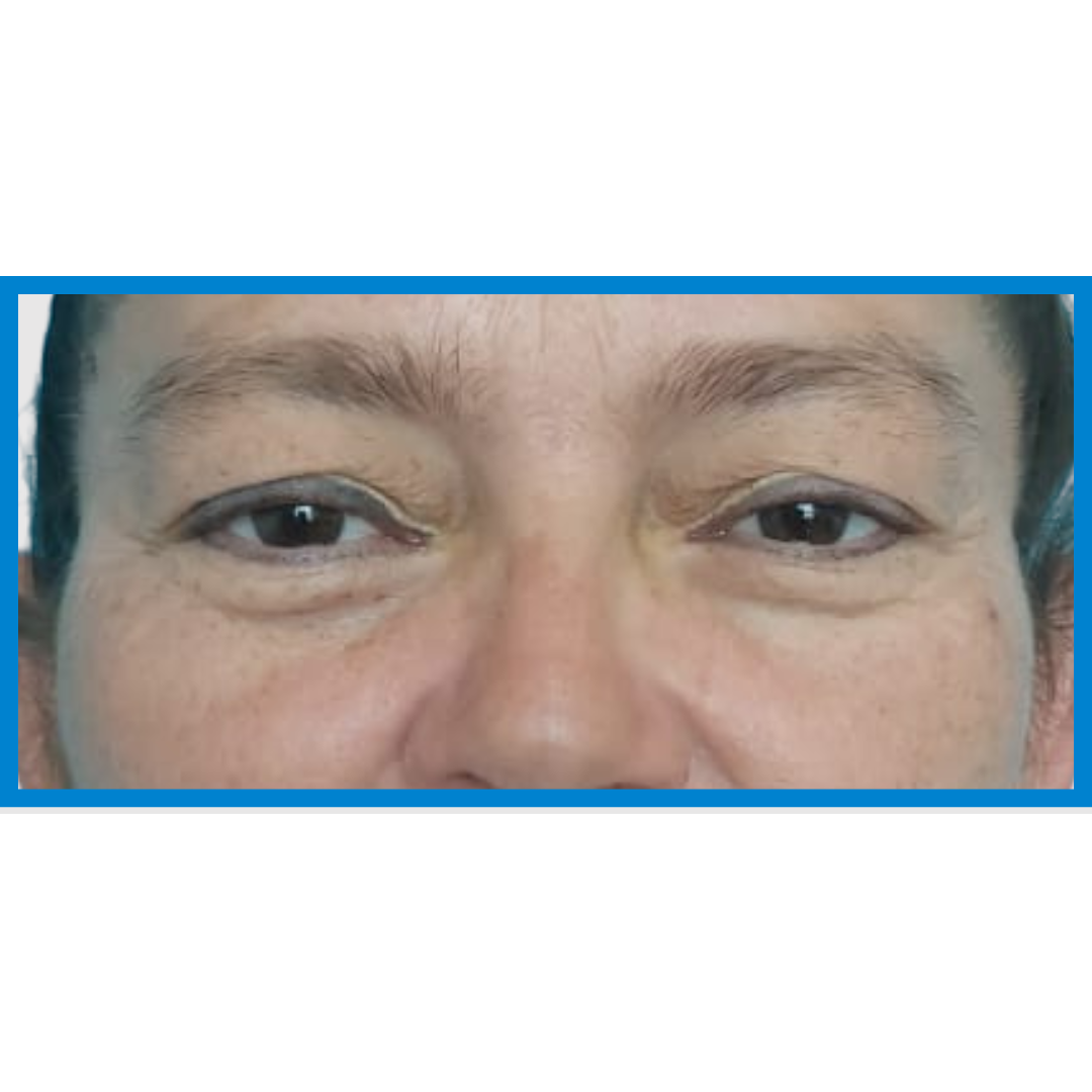 Before-Blefaroplastia