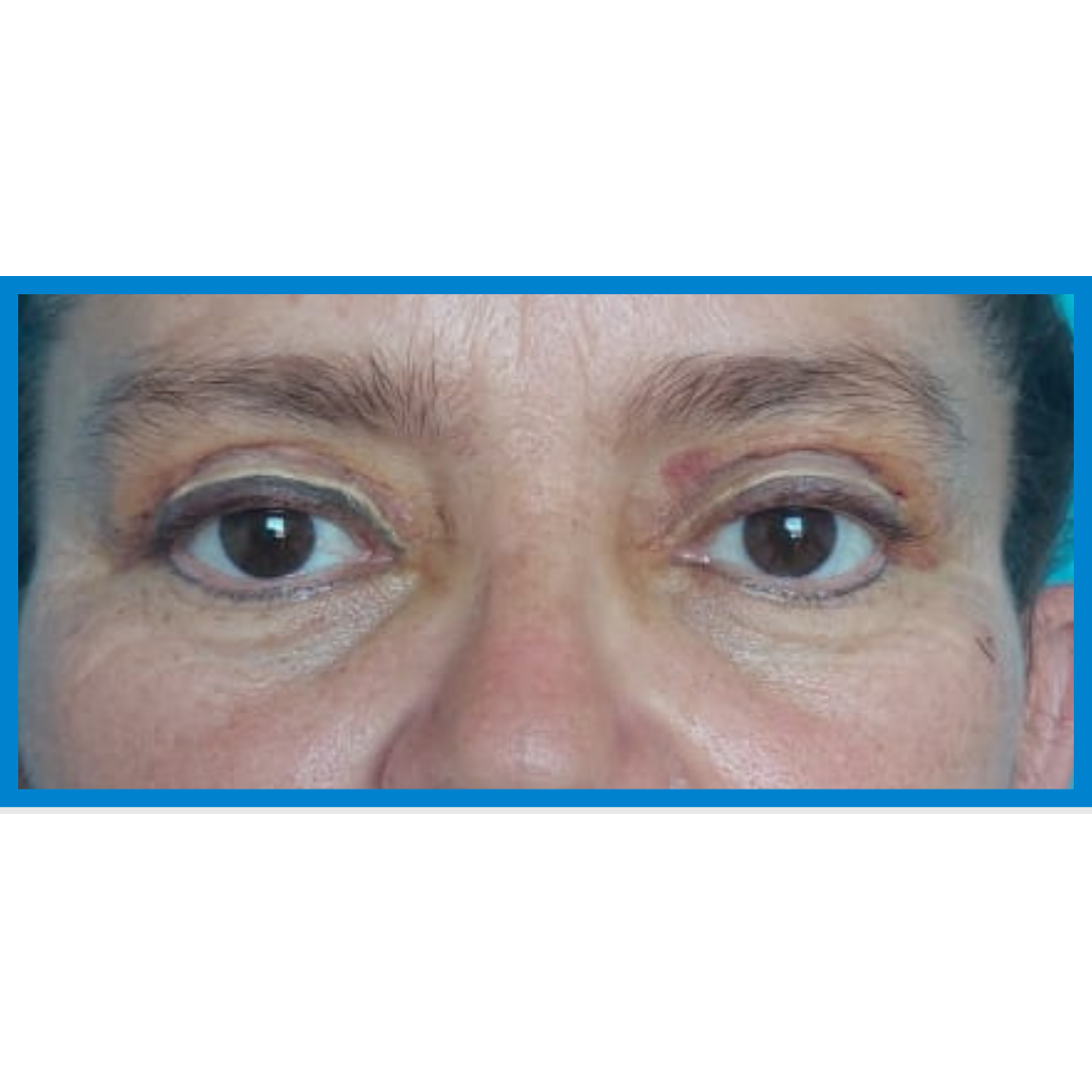After-Blefaroplastia