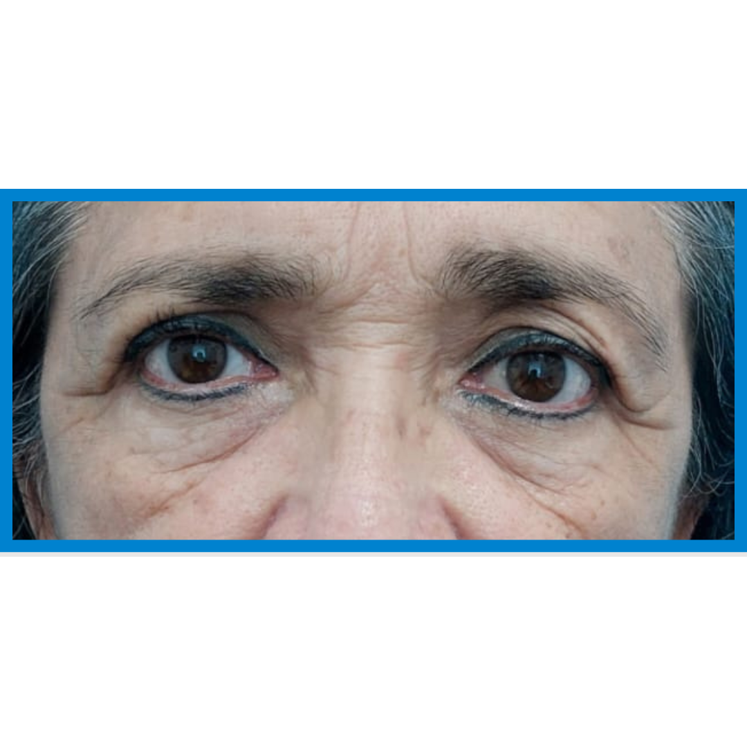 Before-Blefaroplastia