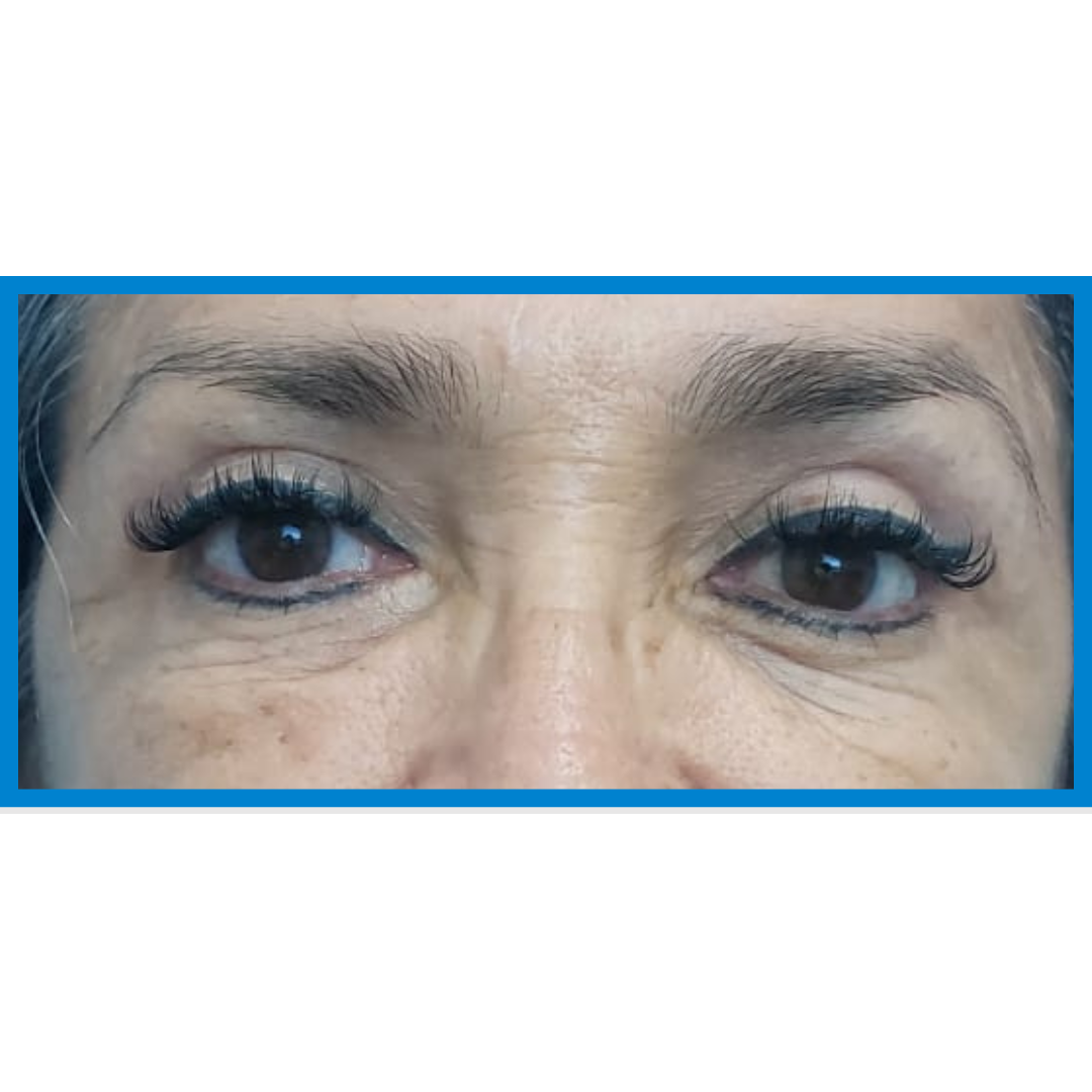 After-Blefaroplastia