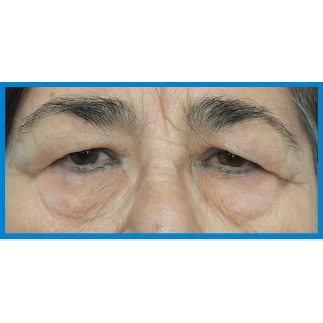 Before-Blefaroplastia