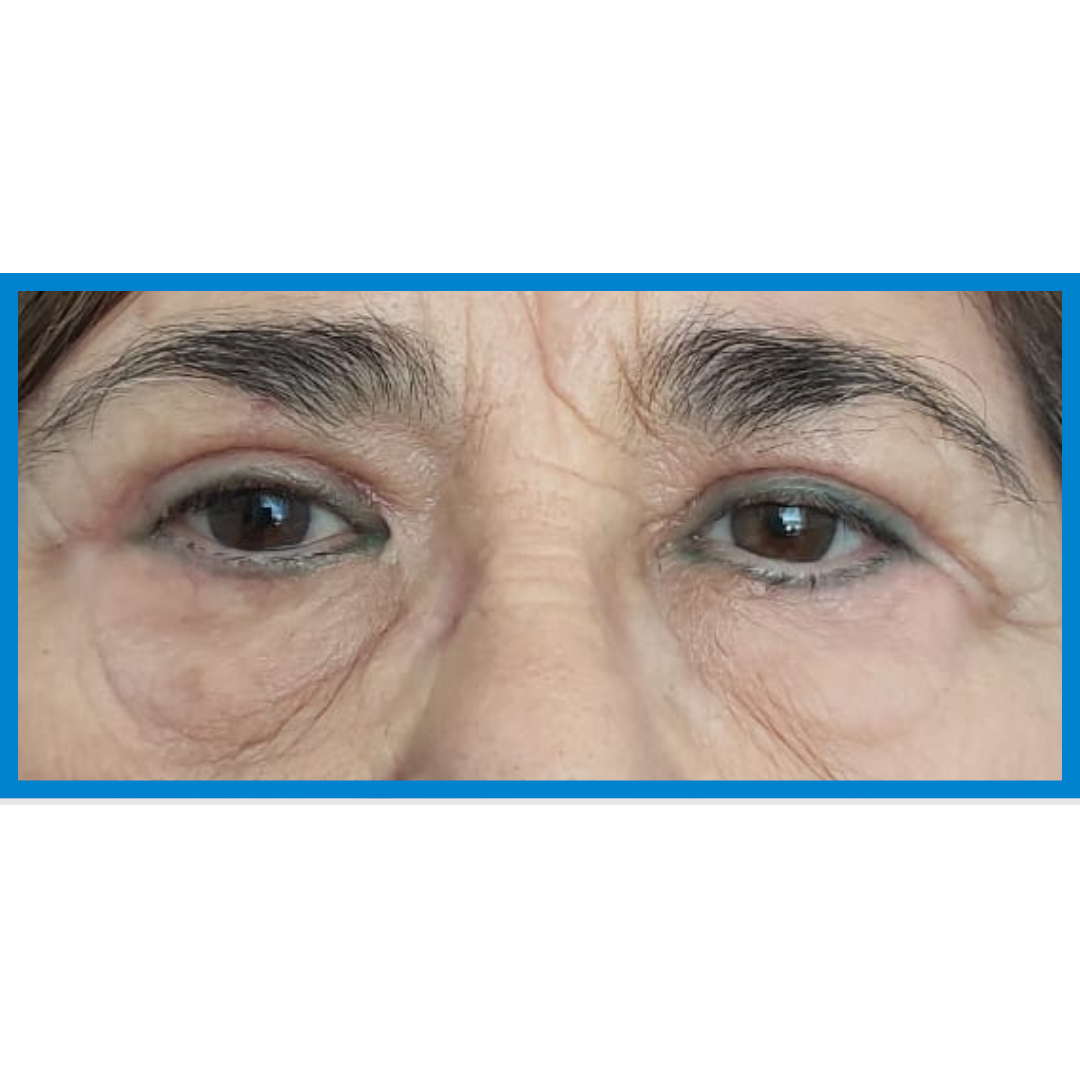 After-Blefaroplastia