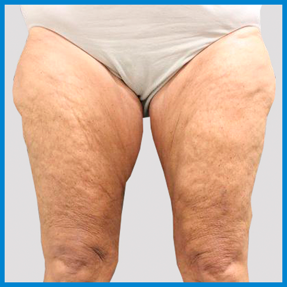 Before- Cruroplastía