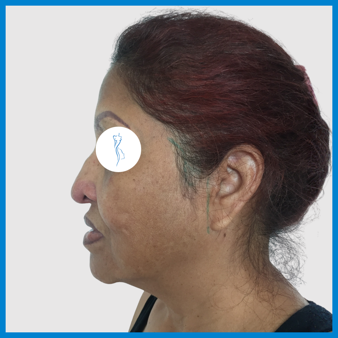 Before-Lifting de Cara y Cuello
