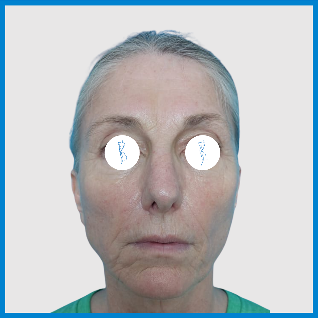 Before-Lifting de Cara y Cuello