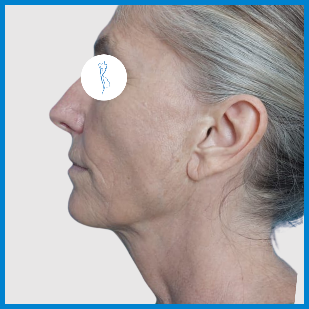 Before-Lifting de Cara y Cuello