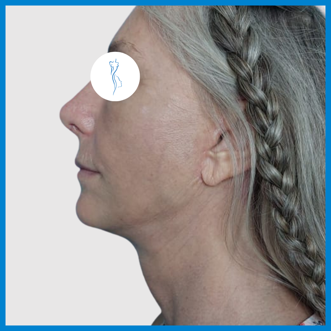 After-Lifting de Cara y Cuello