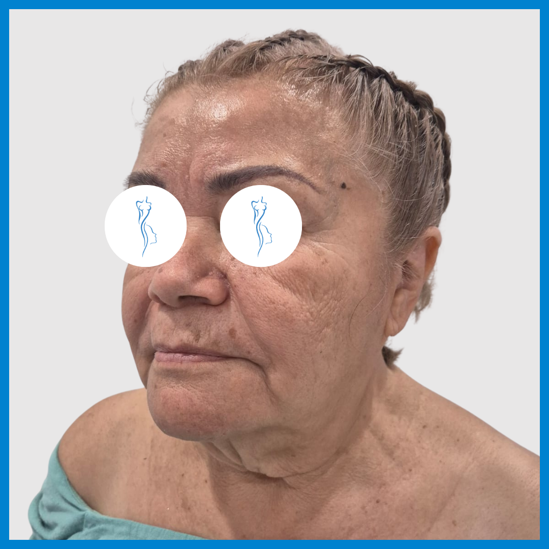 Before-Lifting de Cara y Cuello