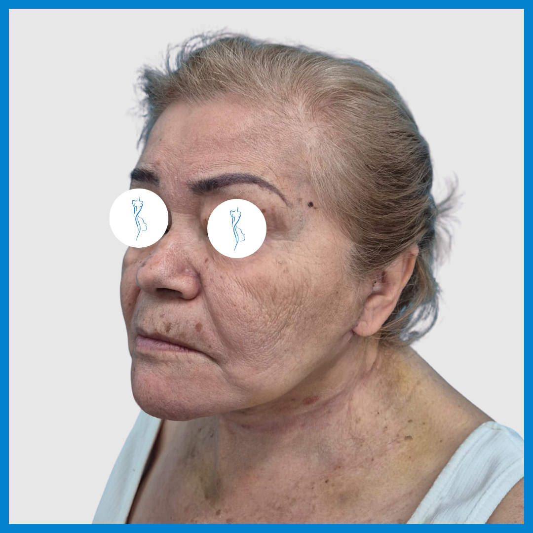 After-Lifting de Cara y Cuello