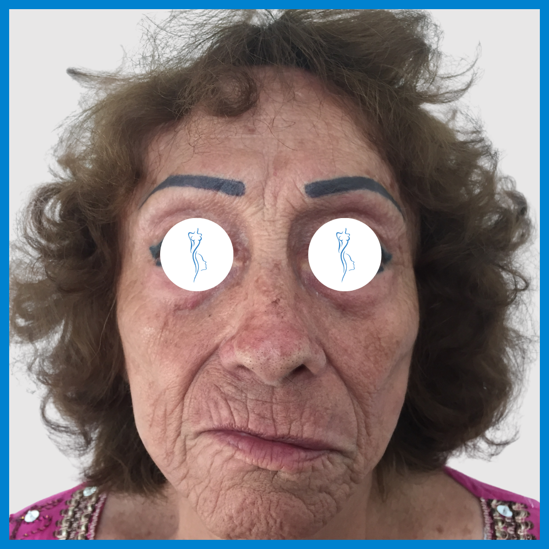 Before-Lipoinyección Facial