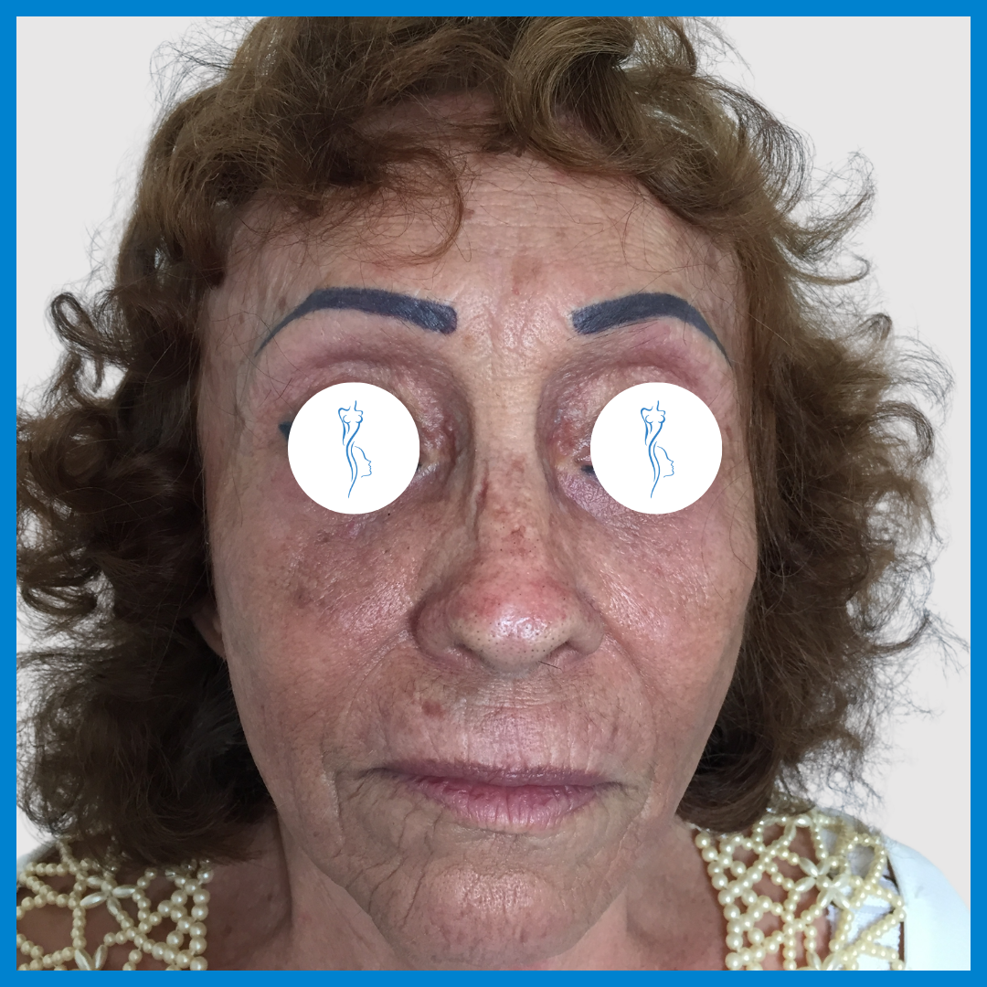 After-Lipoinyección Facial