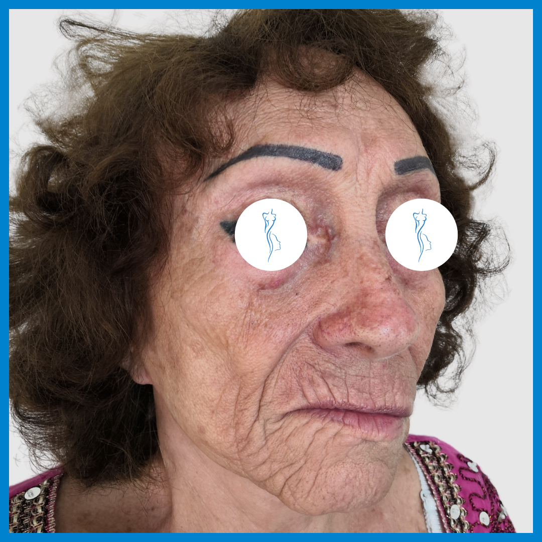 Before-Lipoinyección Facial