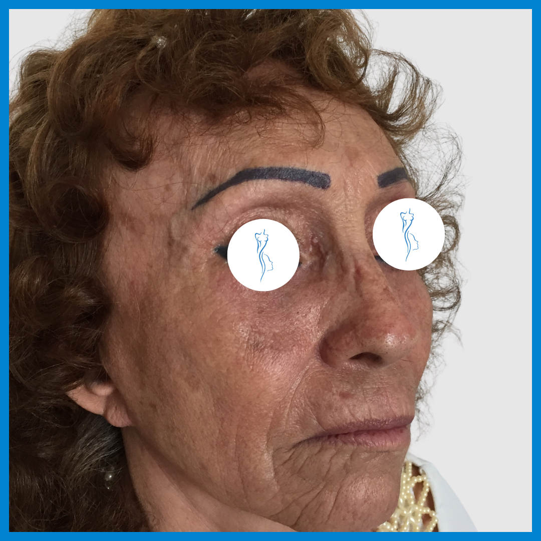 After-Lipoinyección Facial