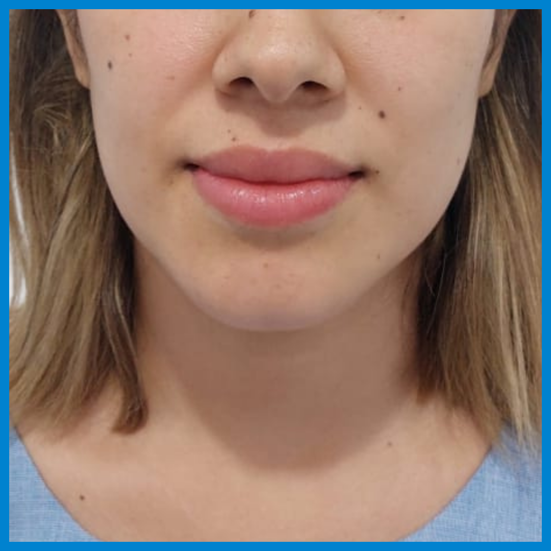Before- Liposucción de cara
