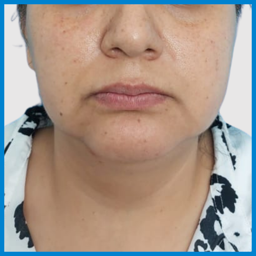 Before-Liposucción de cara
