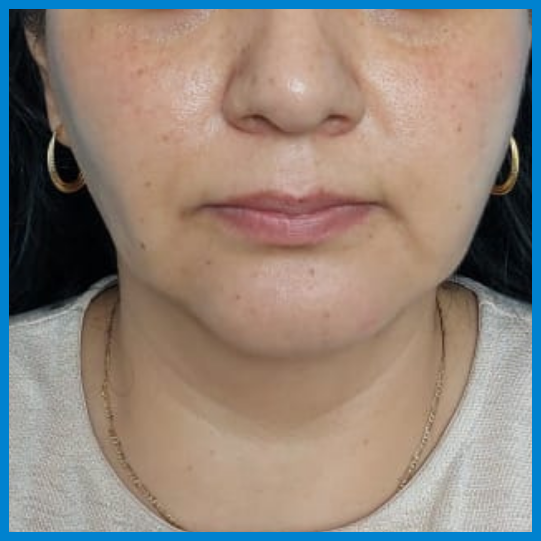 After-Liposucción de cara
