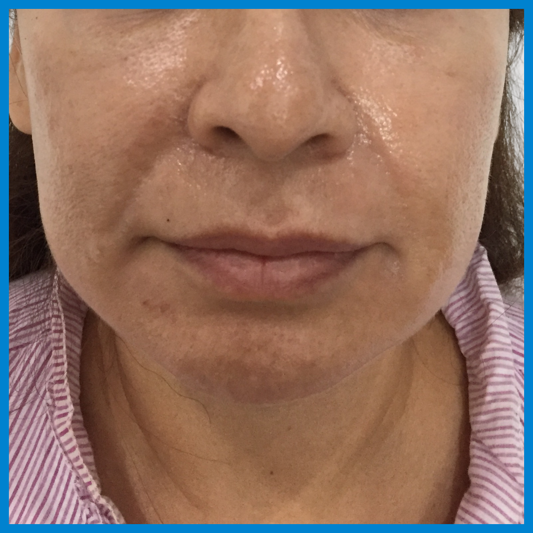 Before- Liposucción de cara
