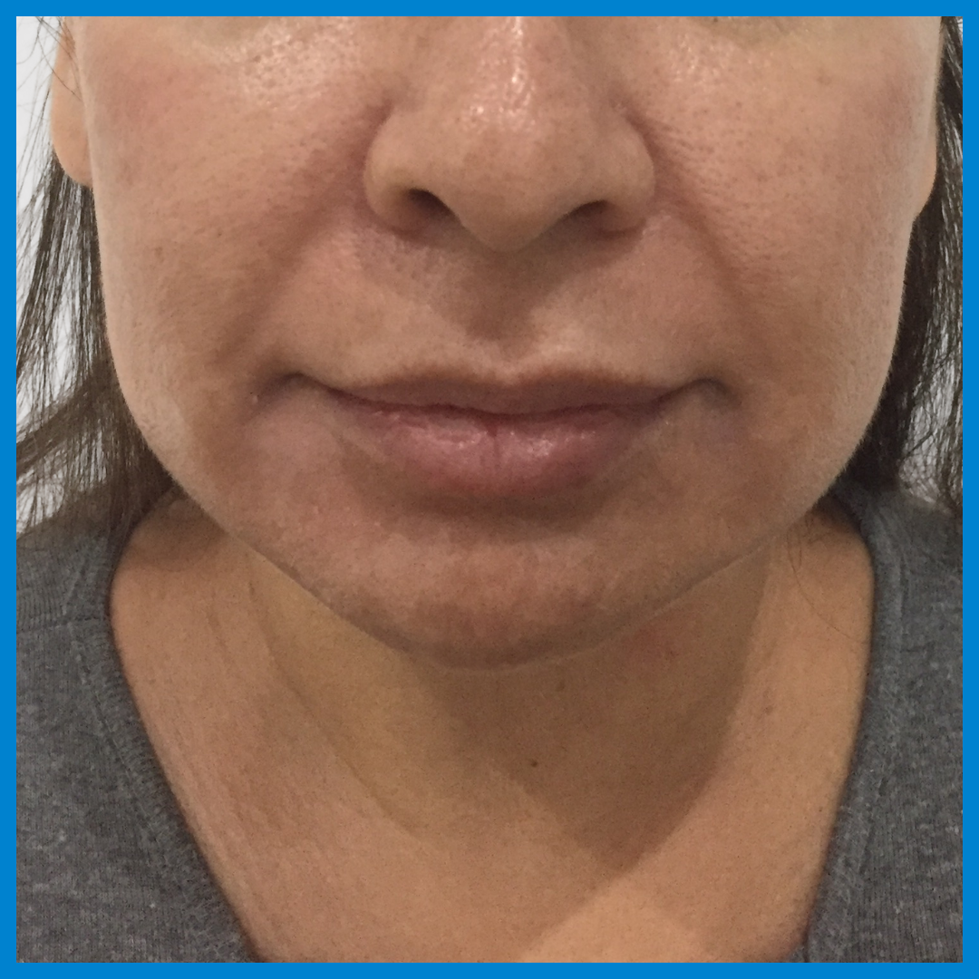Before-Liposucción de cara