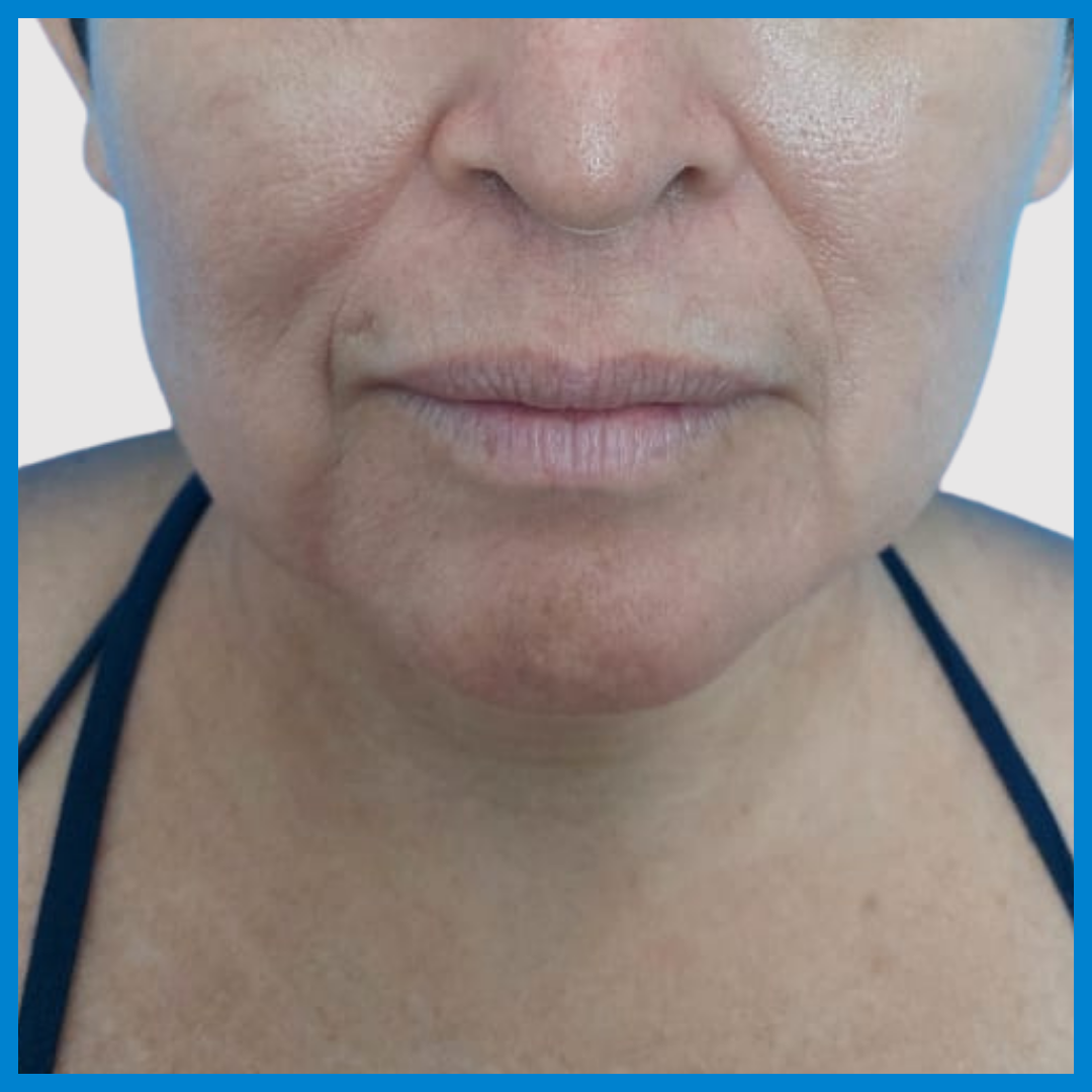 Before-Liposucción de cara