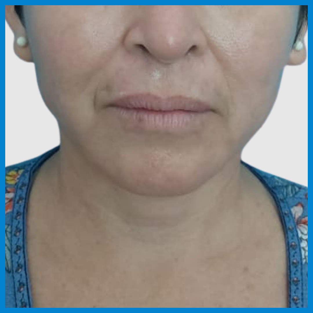 After-Liposucción de cara