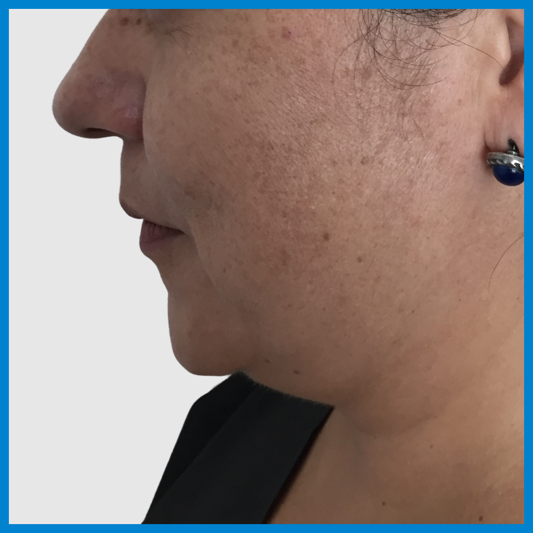 Before- Liposucción de Cuello