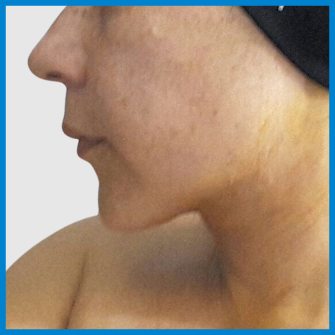 After- Liposucción de Cuello