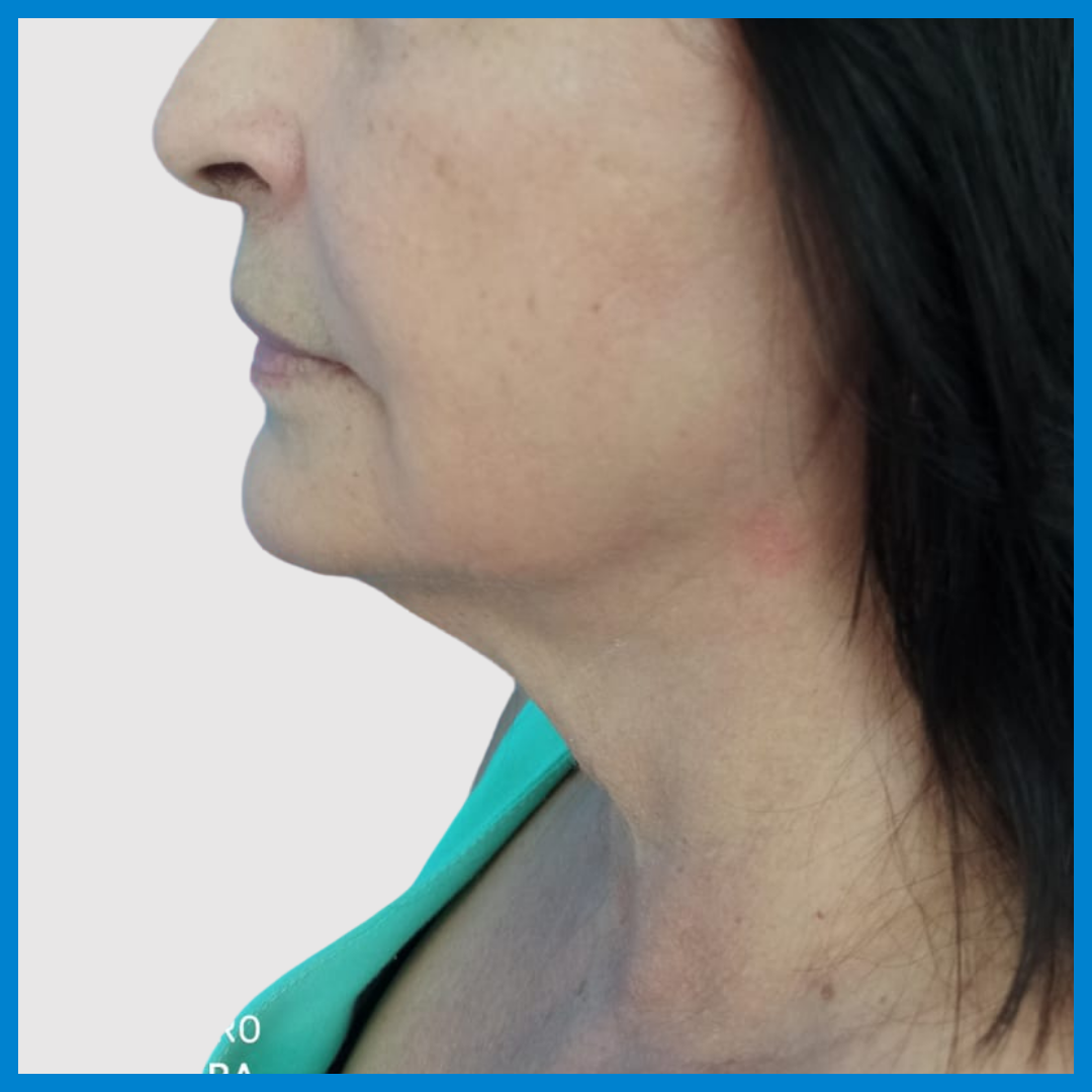 Before- Liposucción de Cuello
