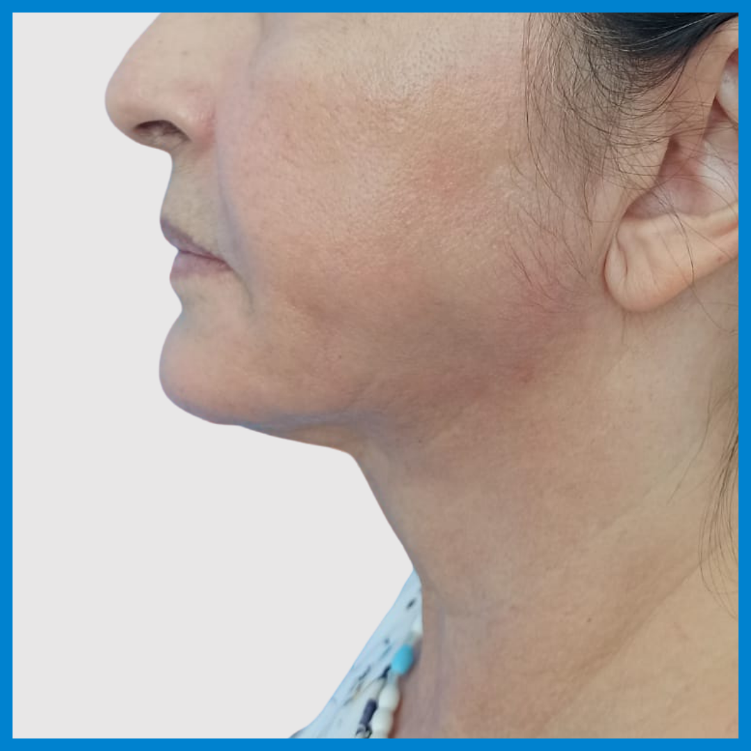 After- Liposucción de Cuello