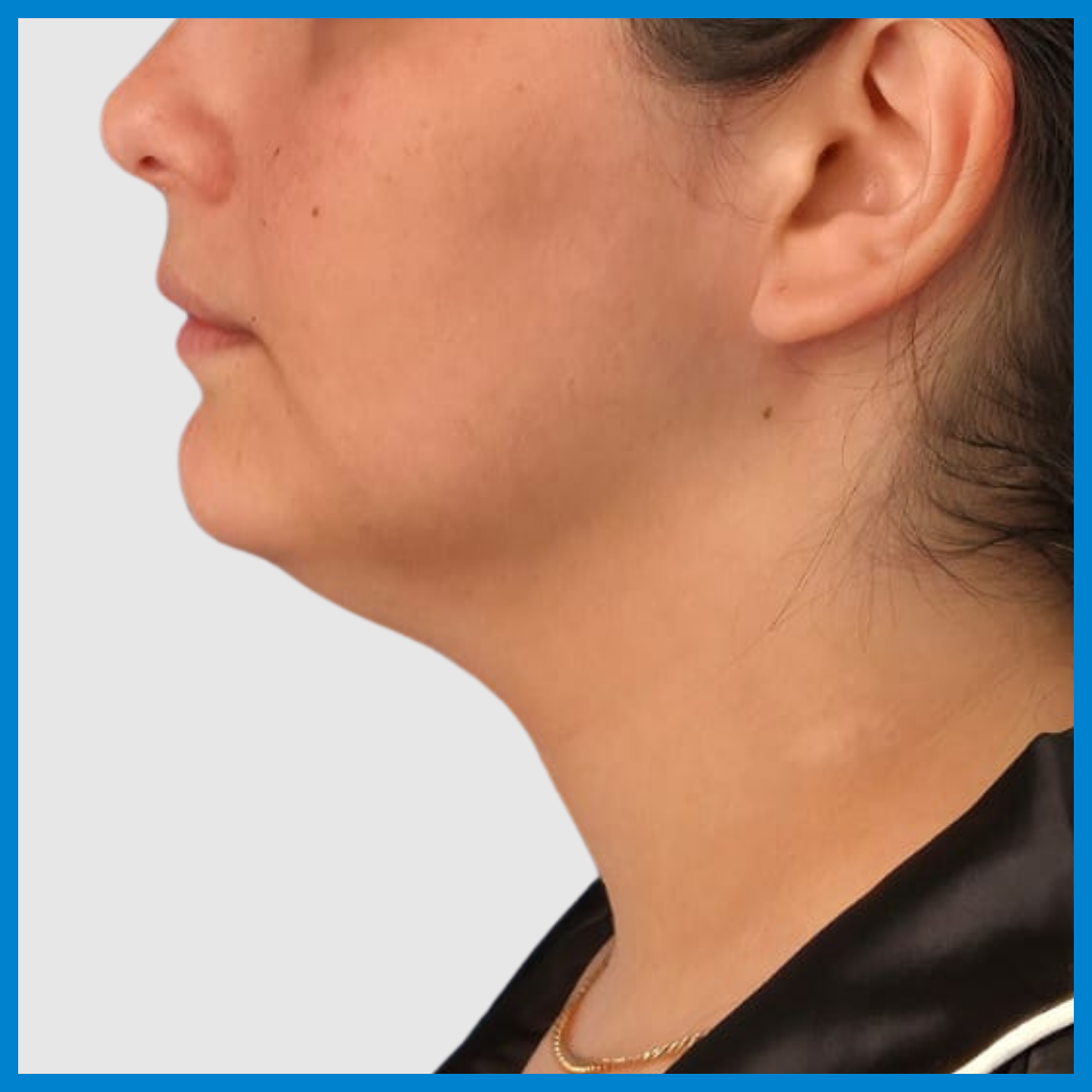 Before- Liposucción de Cuello