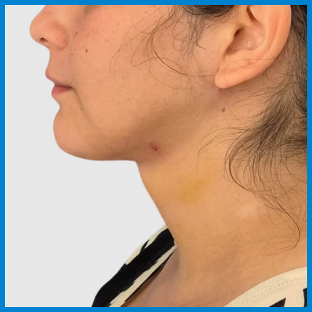 After- Liposucción de Cuello