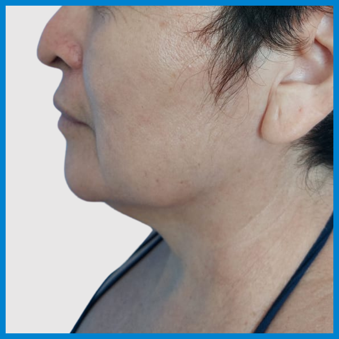 Before- Liposucción de Cuello