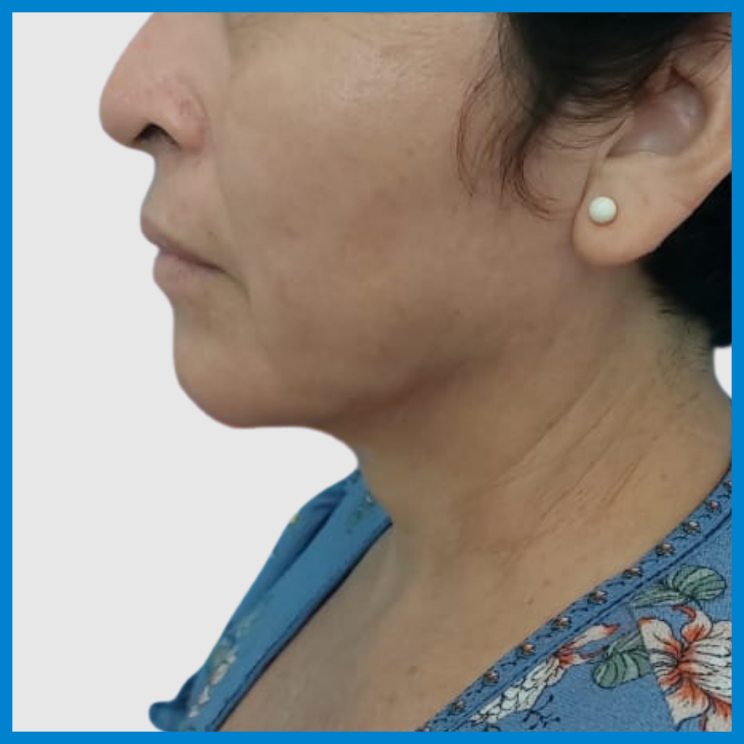 After- Liposucción de Cuello