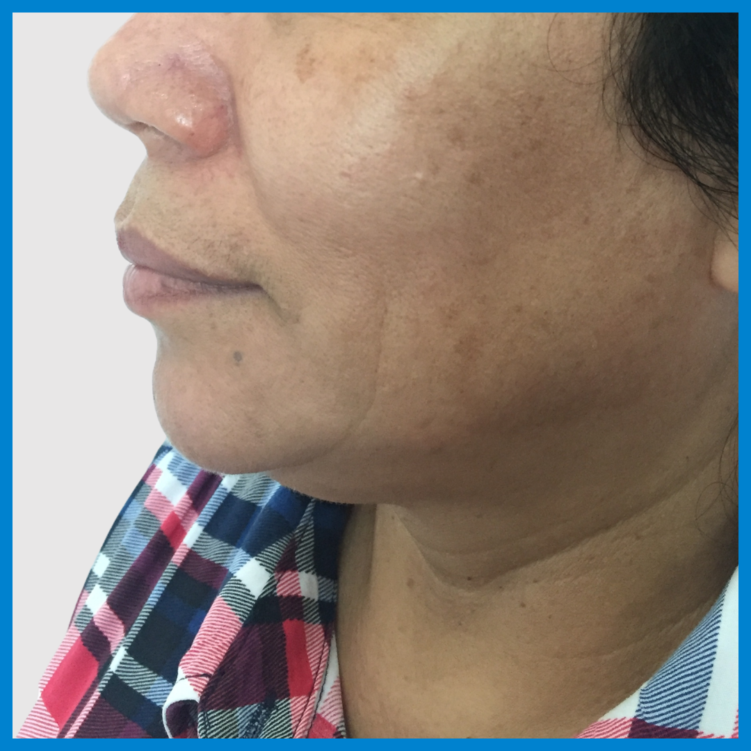 Before- Liposucción de Cuello