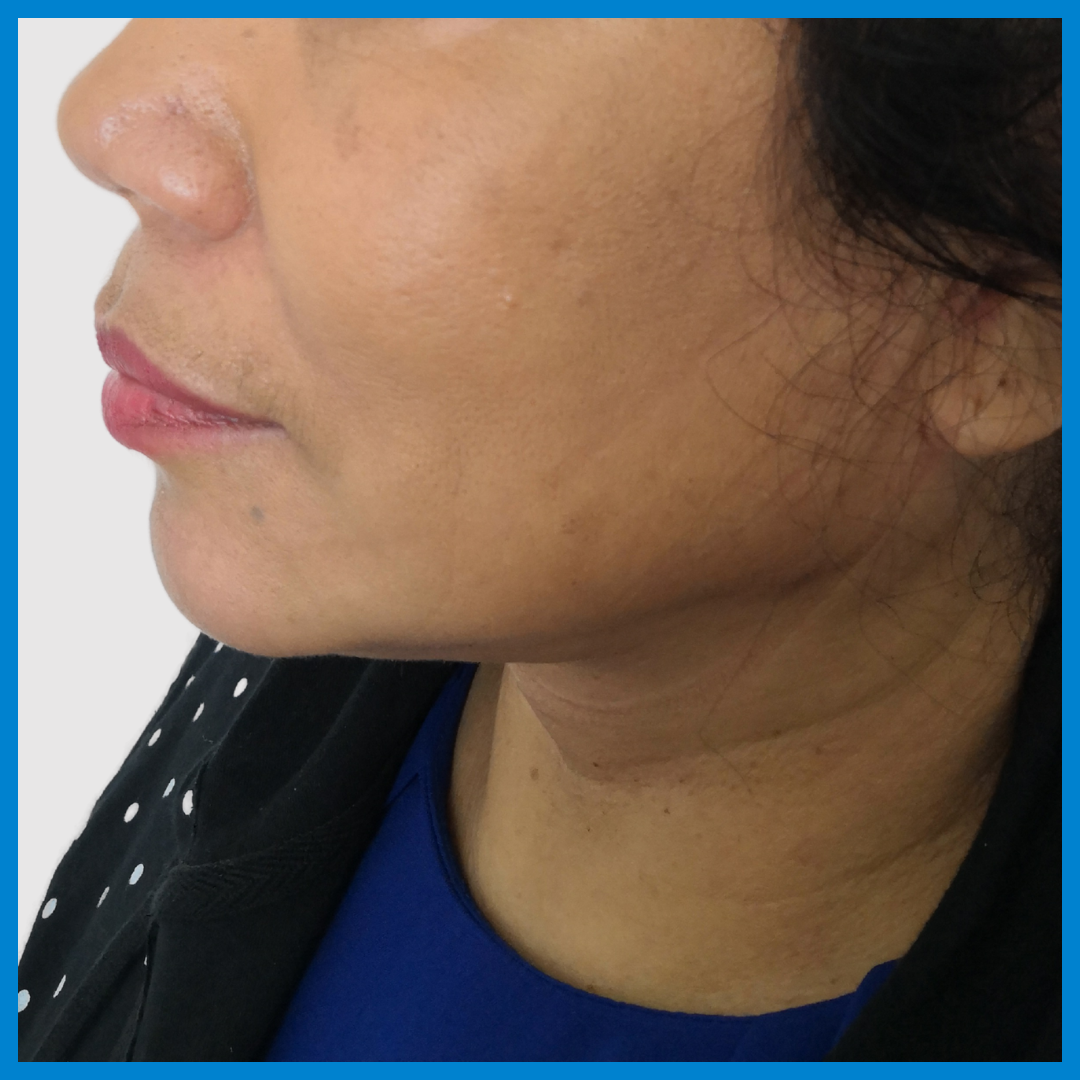 After- Liposucción de Cuello