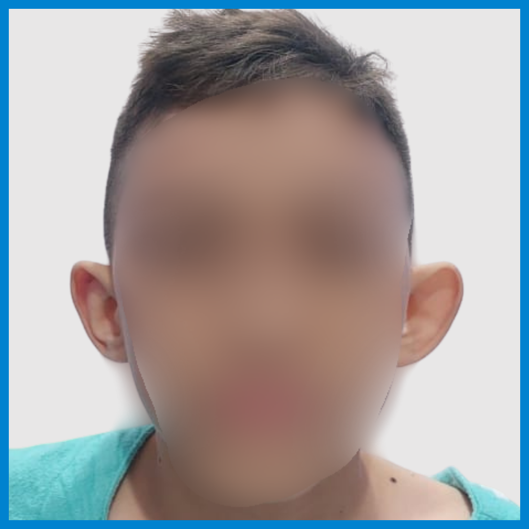 Before-Otoplastia