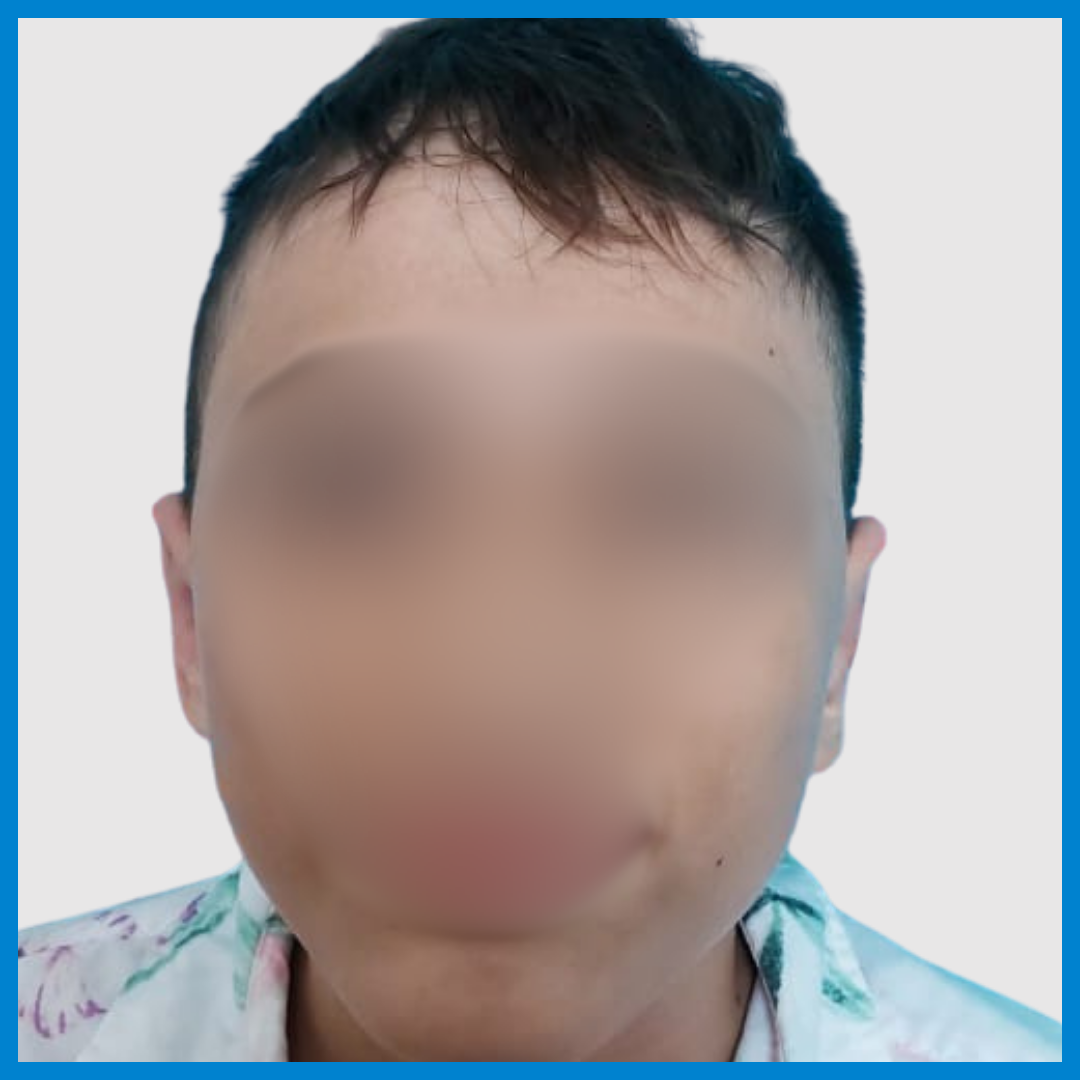 After-Otoplastia