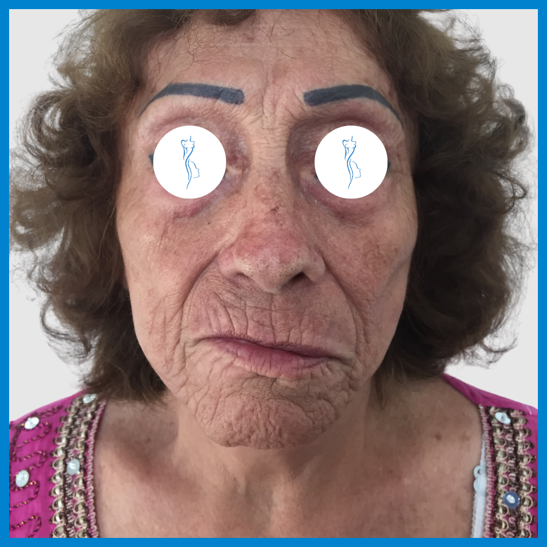 Before-Lipoinyección Facial