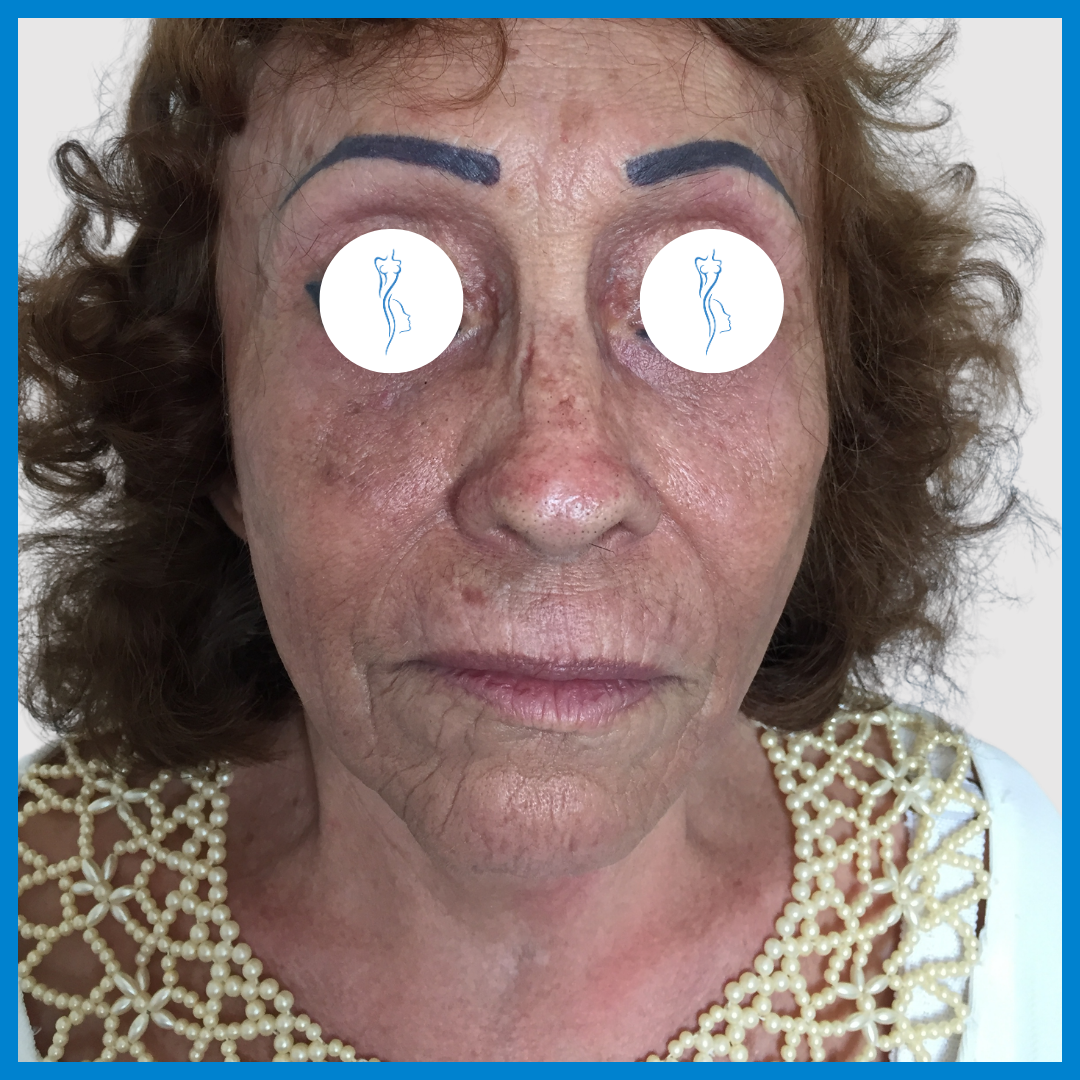 After-Lipoinyección Facial
