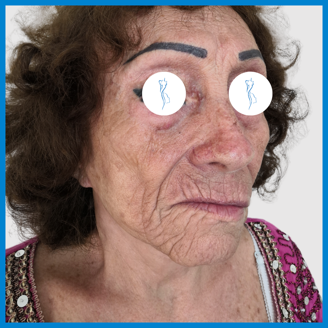 Before-Lipoinyección Facial