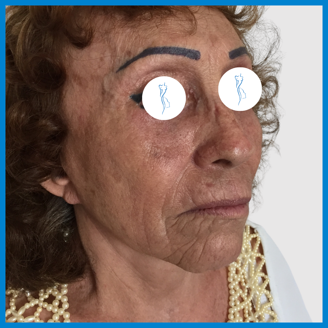 After-Lipoinyección Facial