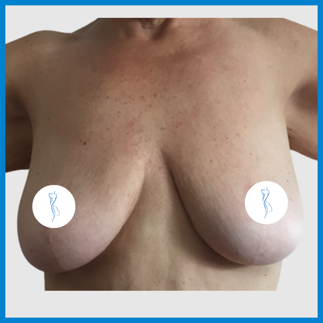 Before-Mastopexia