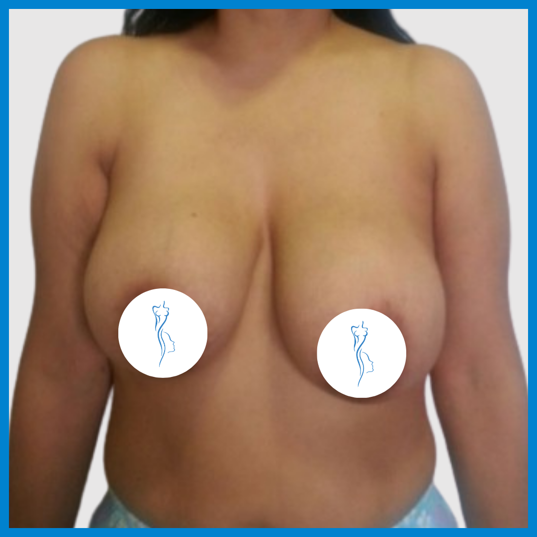 Before-Mastopexia
